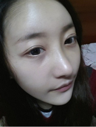 双眼皮修复改善大小眼+开内眼角+硅胶隆鼻+自