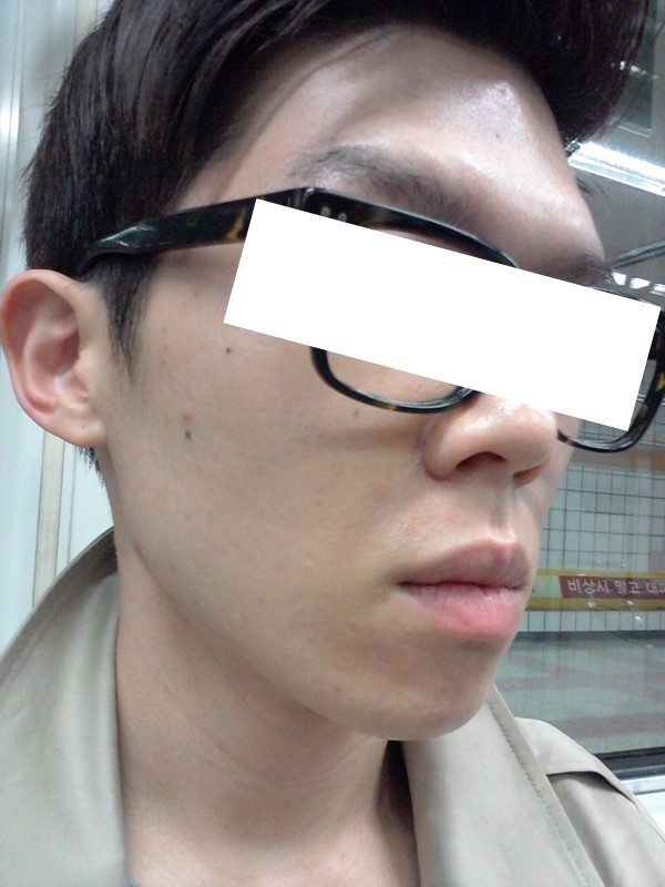 E2+PRP