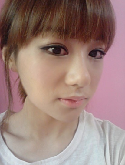 埋线法双眼皮+开外眼角+开内眼角整形手术后