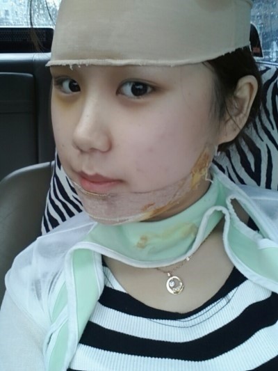 棱角下巴+颧骨+假体植入丰额头整形手术2周后