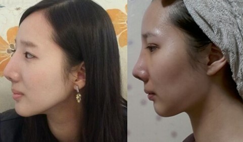 切开法双眼皮修复+切除鼻骨及软骨矫正鹰钩鼻整形手术2周后,你们好~2周前_圈子-新氧美容整形