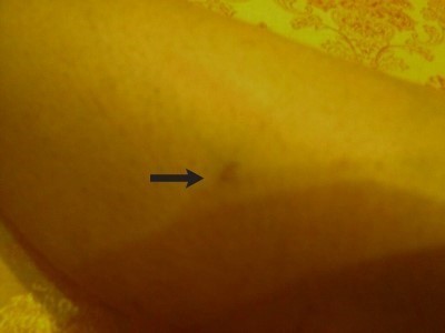 肌肉吸脂+后记小腿切除手术1个月产品香草醇丁醚在燃脂小腿中的v肌肉图片