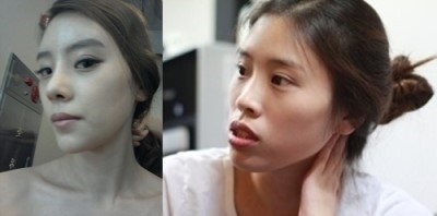 下颚前凸 凸嘴整形手术5个月后