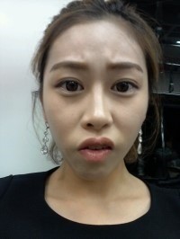 凸嘴整形手术12周后