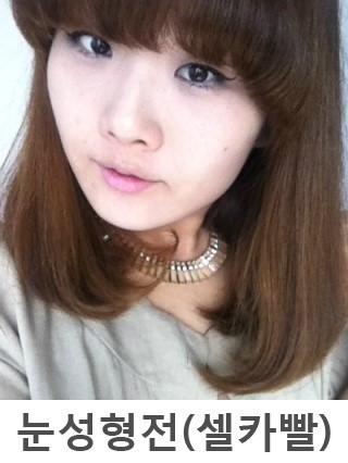 切开法双眼皮+开内眼角+外切法去眼袋整形后