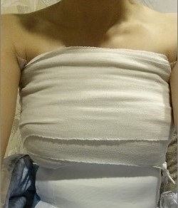 水滴形假体隆胸整形2周后