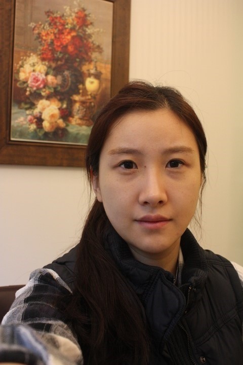 埋线法双眼皮+开外眼角+玻尿酸注射隆鼻2周后