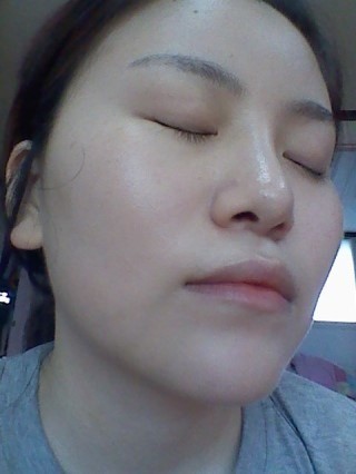 QUICK颧骨缩小+棱角下巴矫正+假体植入矫正