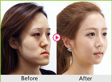 双鄂手术可以有效的改善长脸,地包天,颜面不对称,咬合不齐等多