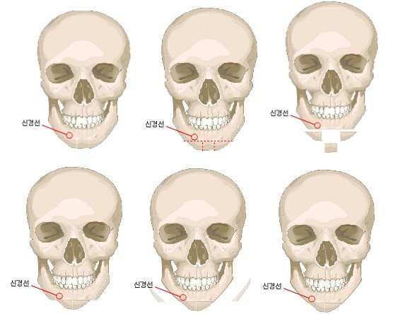 INE瓜子脸手术,V-LINE瓜子脸手术介绍、价格、