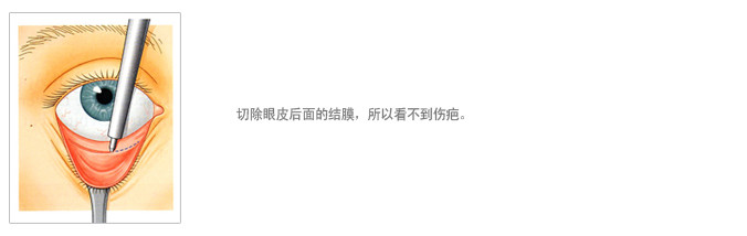 不要担心会留伤疤手术部位是在眼内部结膜上,所以看不到伤疤2.恢