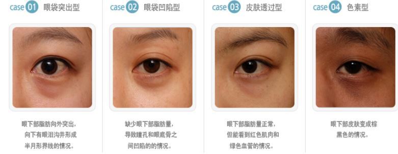 黑眼圈分类韩国整形医院赵恩辛整形外科向大家对黑眼圈的类型和治疗