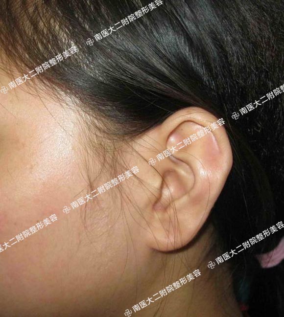 图片)本篇主要介绍先天性小耳症的耳再造,我们主要使用乳突区皮肤扩张