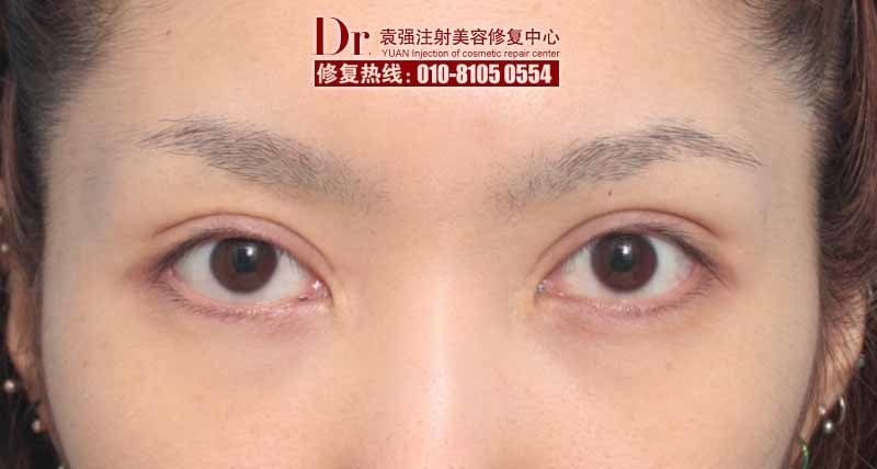 宽大型双眼皮修复:一直以来,宽大的双眼皮让这位女士忧郁寡欢,双眼皮