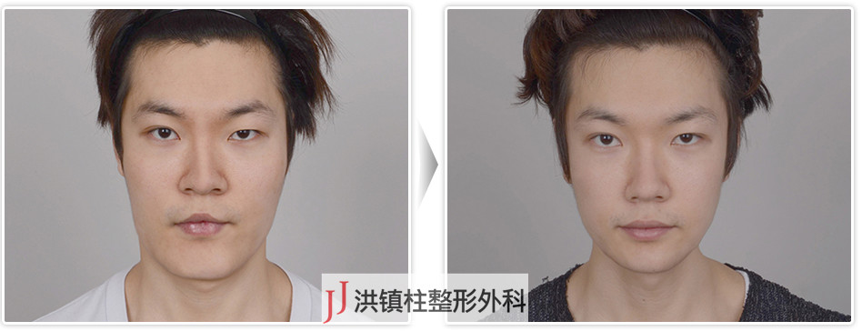 jj洪镇柱整形外科医院-长脸矫正术