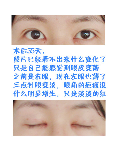 【韩式三点 开眼角 7mm 扇形】想做双眼皮的妹子们进来看看咯