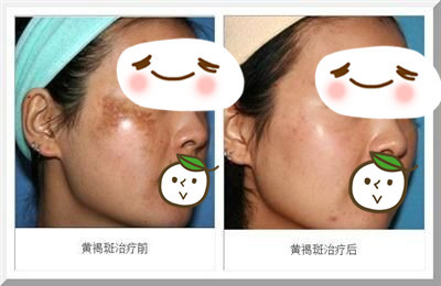 脸上黄褐斑惊喜不断美姿尔