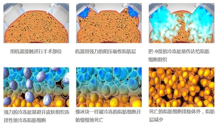 sm整形外科—冷冻脂肪瘦身.