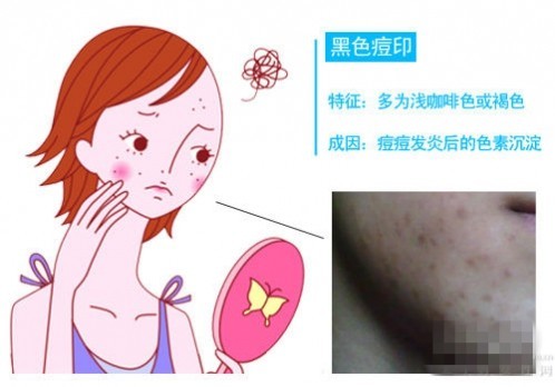 【青春走了,青春痘也走了,可痘印痘疤留下了!咋整?】