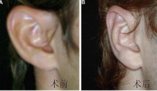 招风耳的并发症一般是这样的情况,有时耳朵在术后会出现血肿;这需要用
