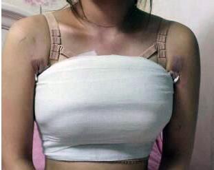 大家好,请问哺乳后乳房松弛,下垂怎么办?有什么办法可以用么?