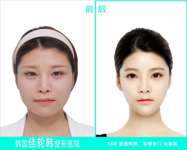 佳轮韩整形外科医院 年末免费模特征集活动