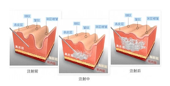 玻尿酸午餐美容,让你悄然变美当注射美容风靡全球的时候,玻尿酸也