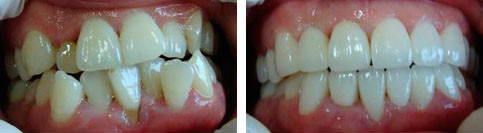 韩国多仁牙科医院牙齿整形,恢复自信时间就是这么短