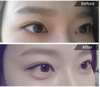 韩国医院做的效果是永久性的 卧蚕眼术后注意事项:   卧蚕眼术后要