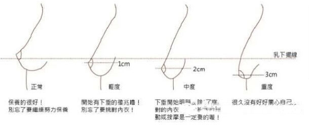 3,一张图教你如何判断乳房有无下垂