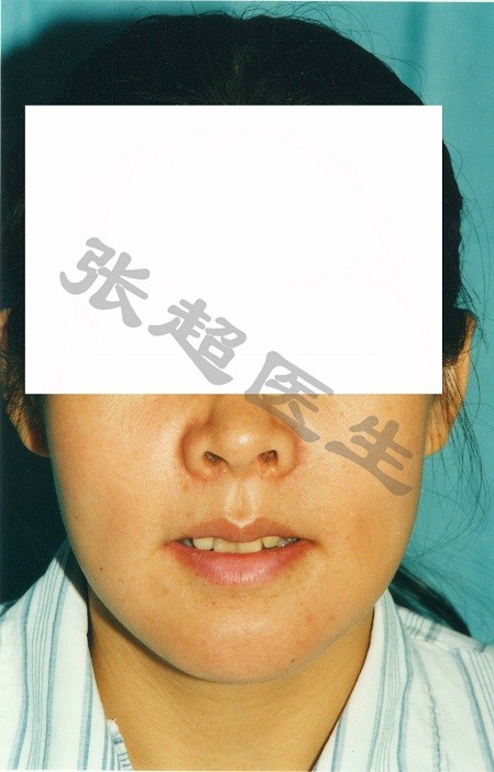 俗称"龅牙"畸形,患者上颌突出,牙齿唇倾,闭口不能,手术为"上颌骨根尖