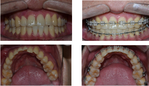 矫正术,是通过陶瓷牙修复手术来矫正畸形牙齿的,来实现牙齿的正常咬合