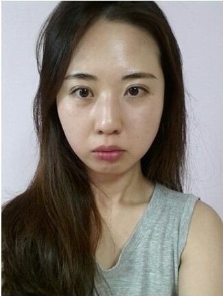 已经做手术8个月了也都消肿了我以前的突嘴,下巴内收,咬合不齐,已经