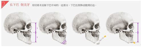 在脸只过度发达下颌的情况叫做倒关牙.