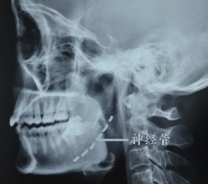 下颌角肥大的不同的截骨手术方式