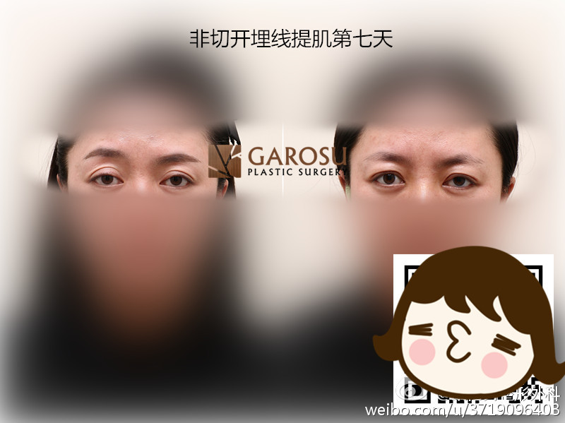 辛小姐10年前得过甲亢,由于甲亢比较严重,眼球有点突出,尤其是右眼