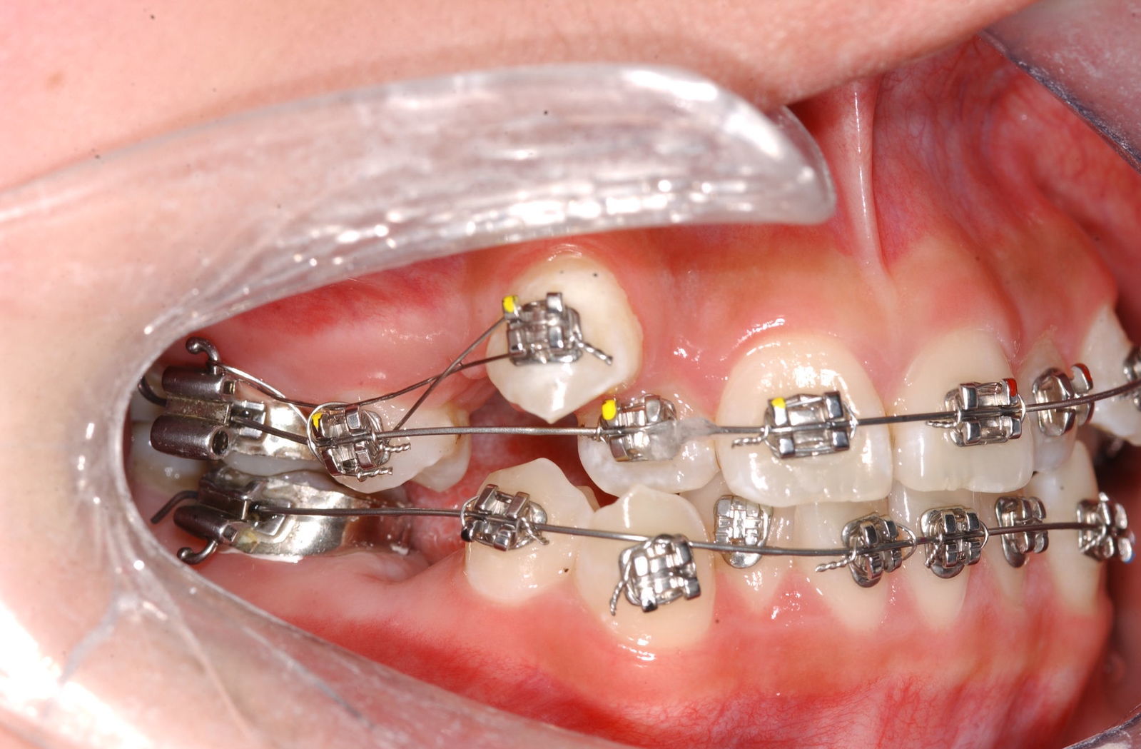 治疗前:牙列重度拥挤伴随单个牙反颌,尖牙高位,中线偏移,咬合紊乱