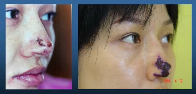 【玻尿酸微整形,完全安全么?(失败事例图,慎入!) 】