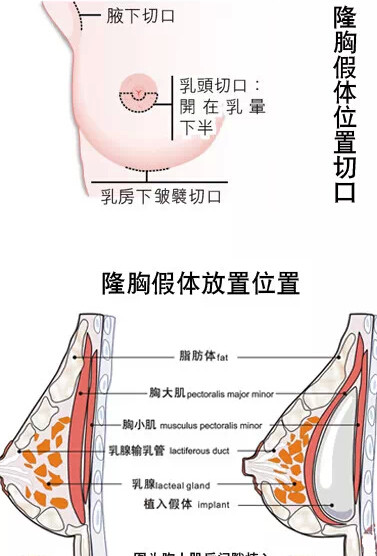 隆胸手术是否影响哺乳主要与 乳腺 和 乳腺导管 有没有被损坏有关.