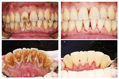 【服务项目】【洗牙】海光博士 进口超声波洁牙 安全无痛 不损伤牙齿