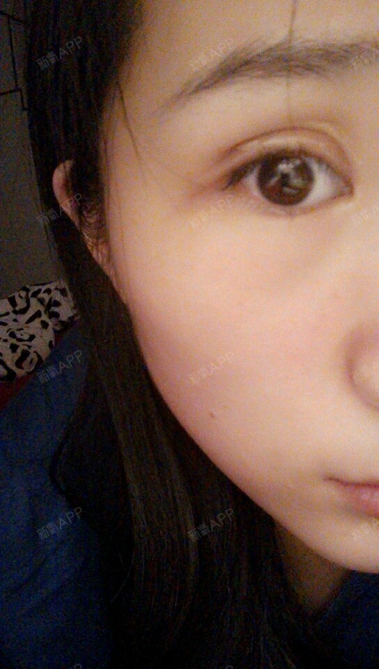 求助双眼皮手术后上眼皮凹陷三眼皮问题