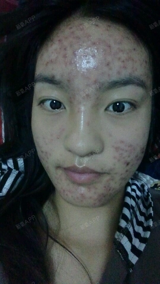 第一次做点阵激光,第一天感觉有点毁容,没有脸