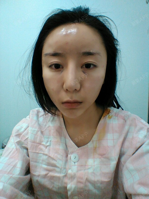 叮当猫?自体脂肪填充全脸第10天美丽日记-新氧