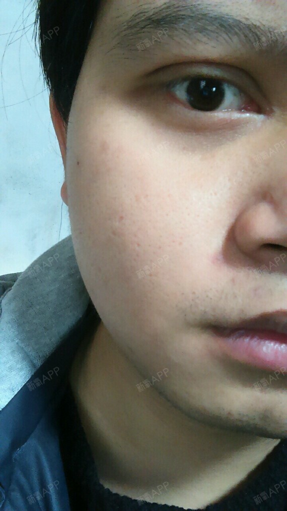 亲,我想问下哪里做激光手术祛痘的,哪里比较好