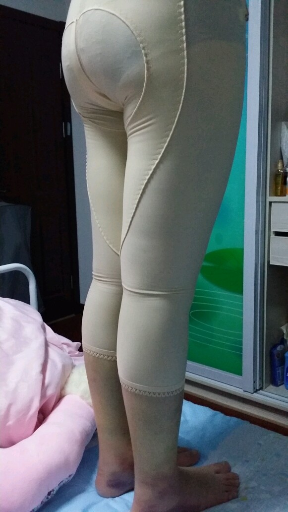 吸脂瘦大腿第9天