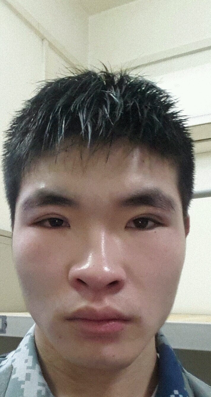 这算不算失败啊,韩式5点已经做了19天了,怎么看着一个眼睛大一个眼睛