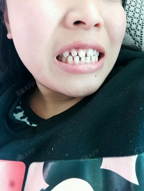 昨天去美立方做的全瓷美容冠,上下牙一共打了