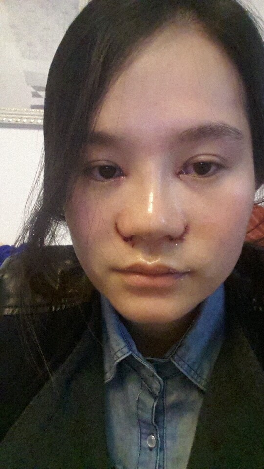 开内眼角怎么样_恢复过程_效果如何_72﹏﹏6491