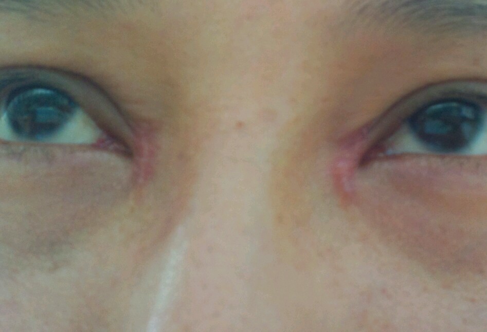 开眼角15天后,亲们这样算不算很严重的增生啊?呜呜呜求解