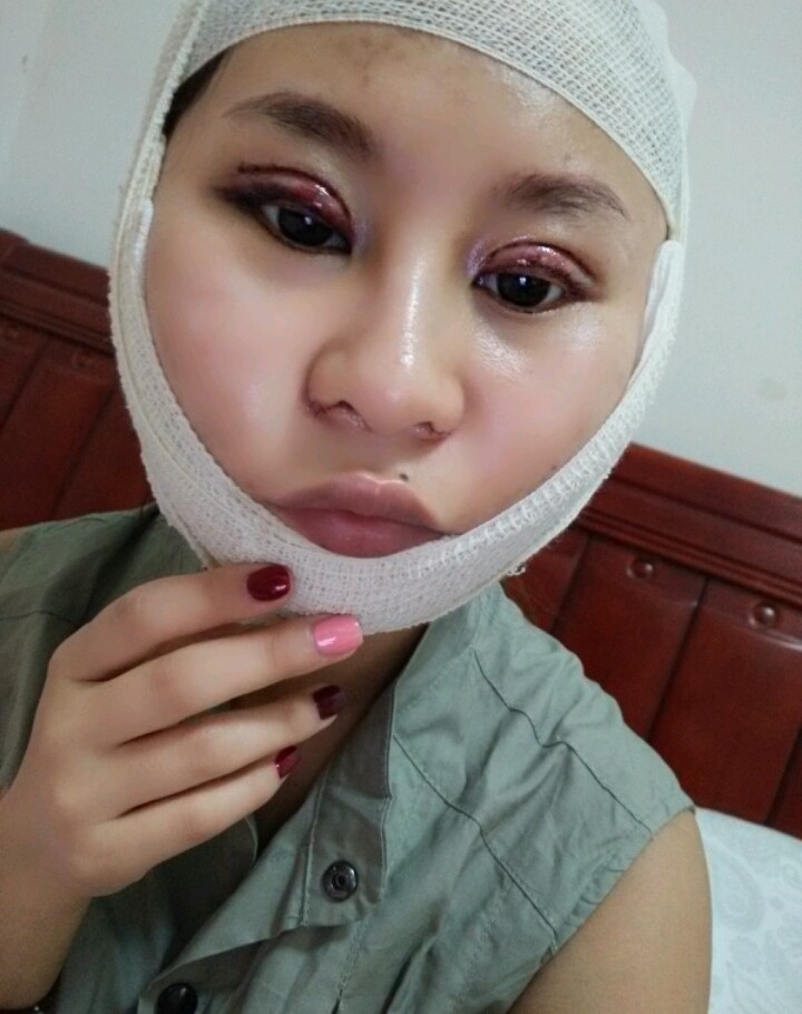 今天是第二天,把双眼皮的纱布取了,还打了点滴,好肿啊